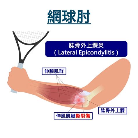 手受傷照片|手肘韌帶受傷會有什麼症狀？該怎麼檢查？(三)